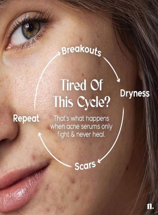 Numour No Breakouts Tonight| Dual Acne face Serum 20ml | 8% Actives 2% Encapsulated Salicylic + 4% Niacinamide + Azelaic Acid & Zinc | Acne‑Prone & Sensitive Skin - Image 2