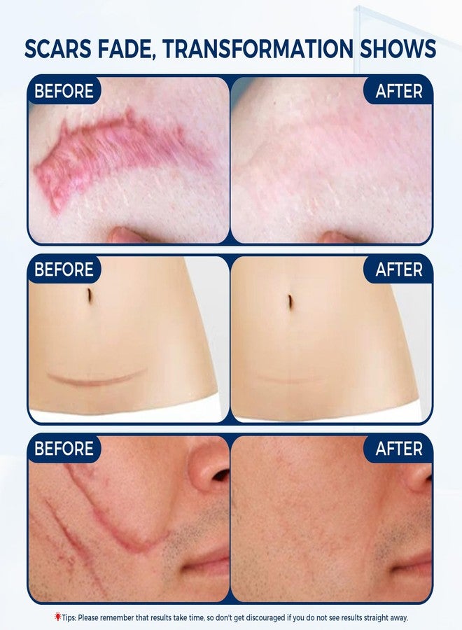 OUKEYA Silicone Scar Gel - 100% Silicone Cream Perfect for Sensitive Skin, Say Goodbye to Old and New Scars (30ml - Image 5