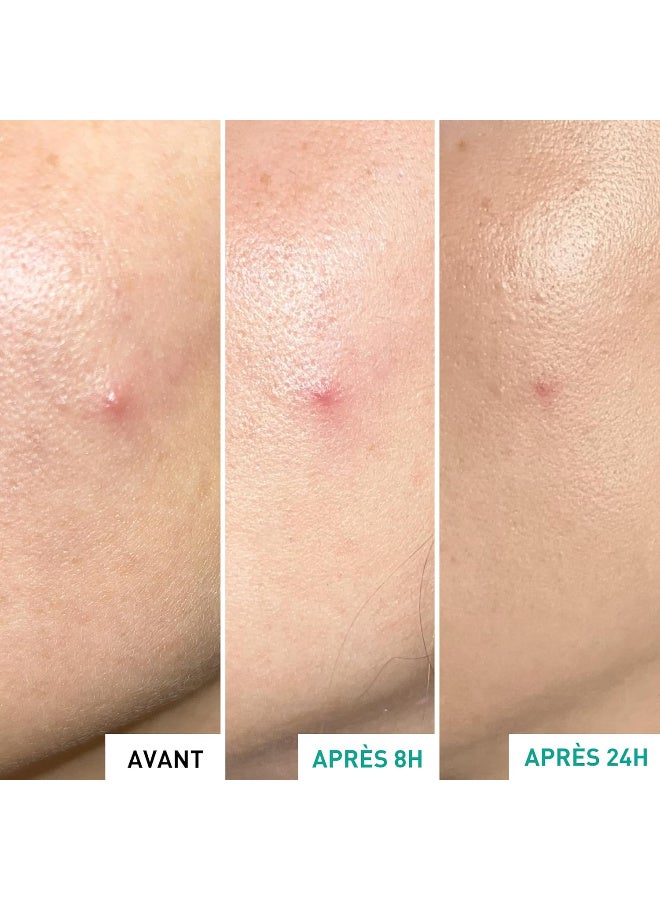 erborian Erborian - Centella Acne Care - Soothing Moisturising Fluid 1% Bakuchiol/Patch Pimple Effect 10% PHA - Acne & Blemish Treatment - Korean Cosmetics - Image 4