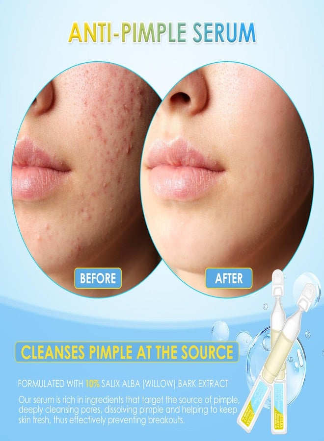 AUSLKA Anti-Pimple Serum Vials, 10% Salix Alba (Willow) Bark Extract Serum, for Oily/Pimple Skin | Oil Control & Eliminate Pimple | Single-Use Vials(1.5ml*30) - Image 2