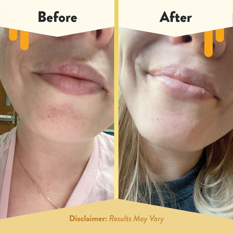 ECZEMA HONEY Nourishing Lip Balm - Organic Chapstick for Sensitive Skin - Daily Lip Moisturizer for Very Dry Lips - Mango Butter & Honey Lip Balm - Natural Lip Care Products (1 Ct) - Image 4