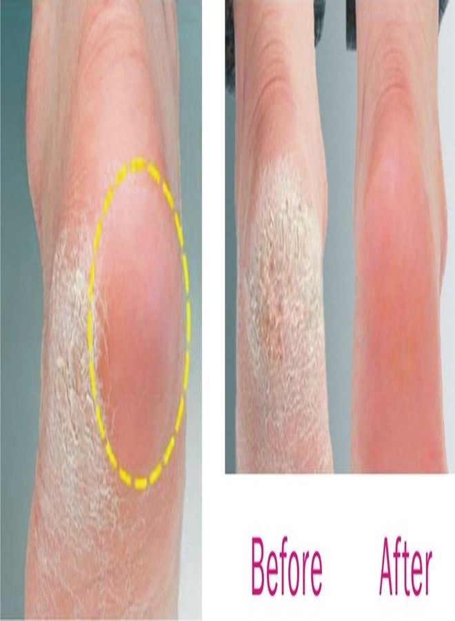 Babila Rechargeable Callus Remover with Free 3 rollers (TC-800R) - Image 4