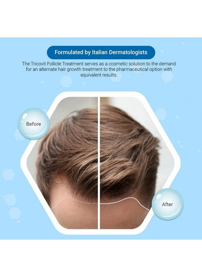 TricoVit - Forte Hair Lotion Hair Growth Serum With Androgen And Dht Blockers For Thinning Hair Promotes Stronger Thicker Hair For Men And Women 5 Ampoules - Image 1