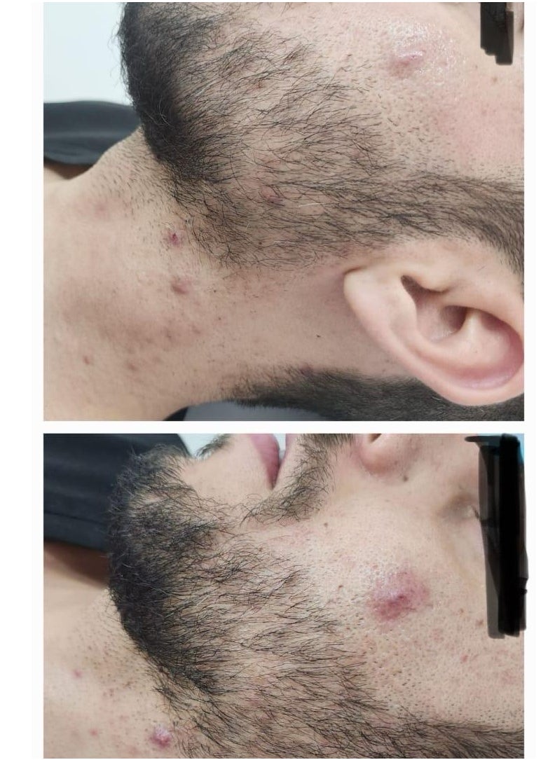 ACE DERMA - Acne treatment - Image 1