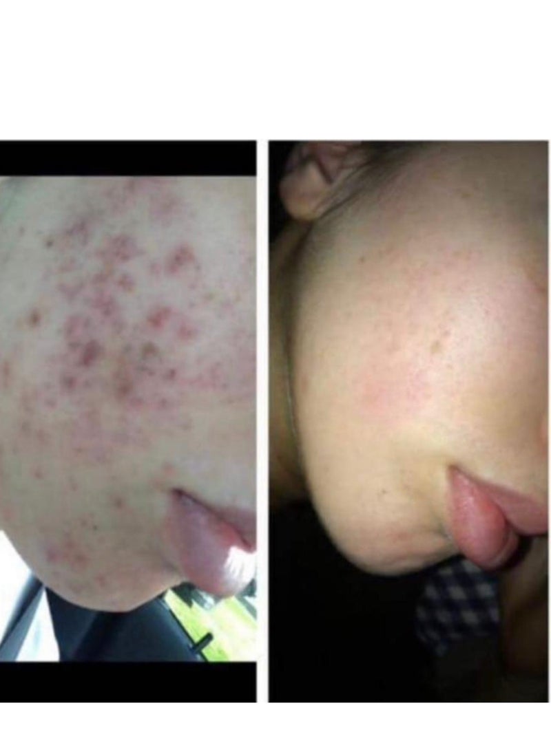 ACE DERMA - Acne treatment - Image 1