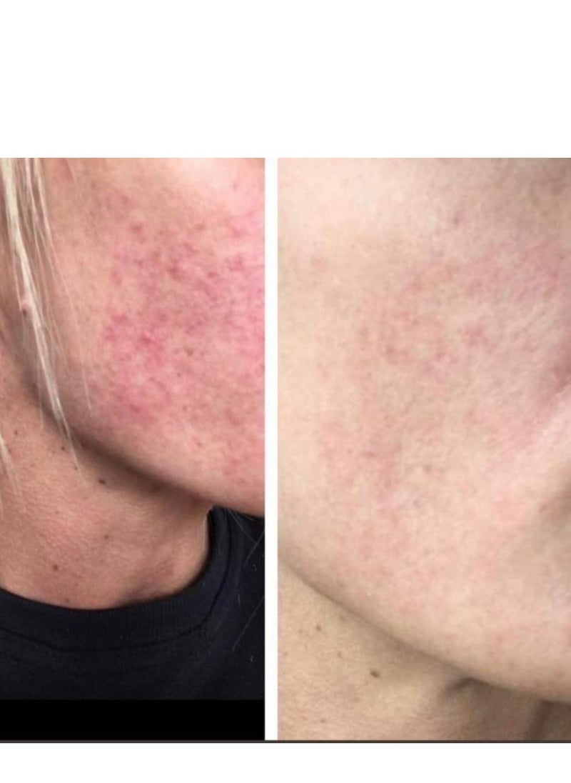 ACE DERMA - Acne treatment - Image 1