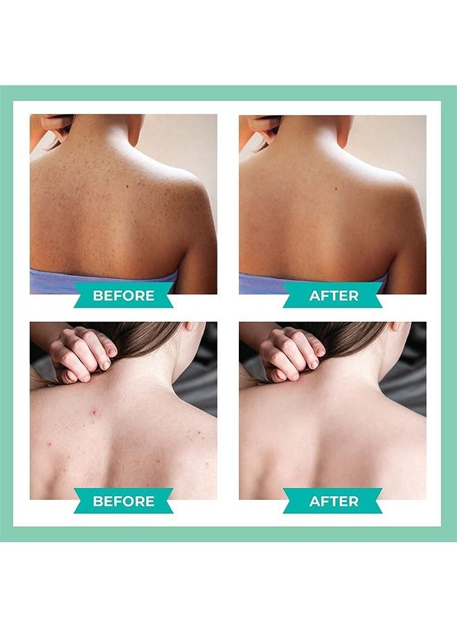 Jaysuing - 120ml Back Acne Treatment, Back Acne Spray, 2% Salicylic Acid Spray, Body Acne Treatment with Herbal Formula, Body Acne Spray, Tea Tree Oil Spray, Acne Treatment For Teens, Back Acne - Image 1