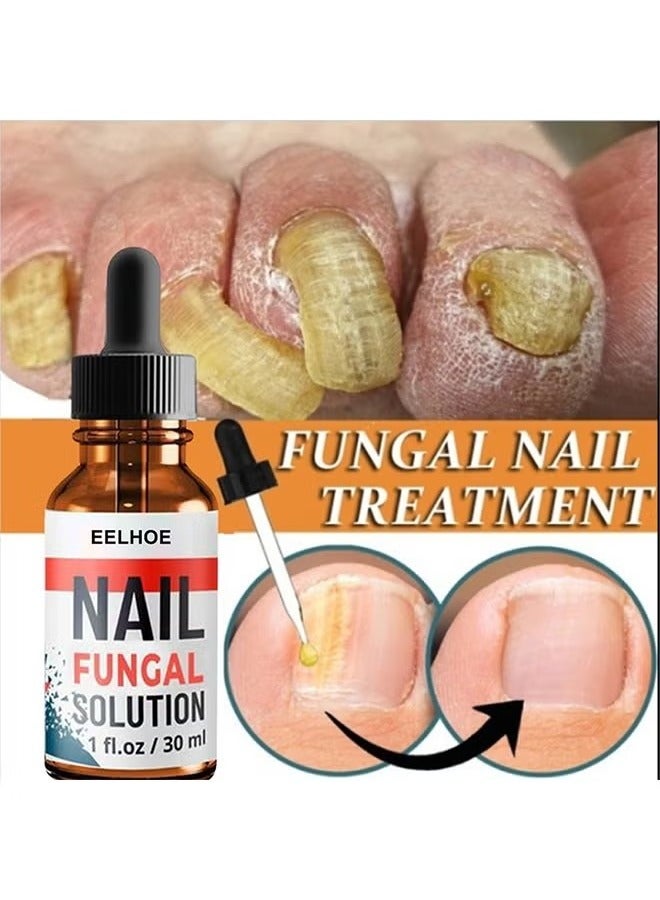 EELHOE Nail Fungal Solution,Fungal Nail Treatment For Toe Nail And Fingernails- Repair Solution For Thick/Broken/Discolored Nails-Renews Damaged Cracked Ingrown Toenail 30ml - Image 1