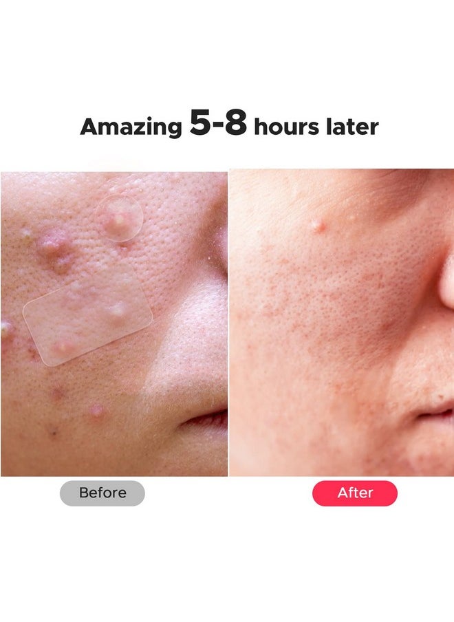 LitBear LitBear Large Pimple Patches, 5 Sizes 156 Patches Big Acne Patches, 60 XL Hydrocolloid Bandages for Full Face, Forehead, Chin, Nose, Body, Back, Neck & Chest, Stirp, Square Large hydrocolloid Patch  - Image 4