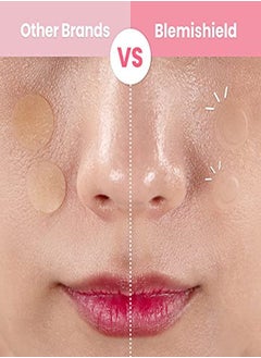Glam Up Hydrocolloid Acne Patches (72 Counts) Invisible Spot Cover For Fast Healing, Absorbing Pimple Treatment Facial Stickers For Zit And Blemishes, 2 Sizes 10Mm & 12Mm  - Image 3