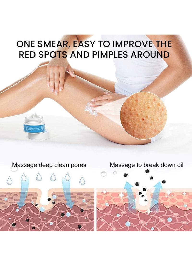Sumifun - Keratosis Pilaris Repair Cream,Vitamin E cream, urea to remove dead skin cells 30g - Image 1