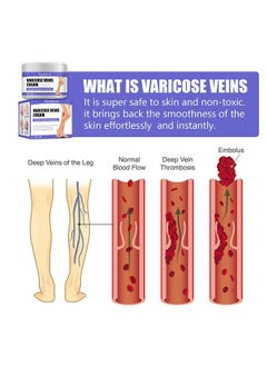 West&Month Varicose Veins Cream to Relieve Phlebitis Angiitis, Varicose and Spider Veins Massage Cream, Relieves Leg Swelling Pain and Fatigue, Improve Leg Appearance 30g  - Image 4