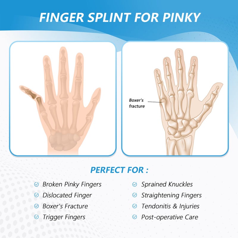 Removable aluminum strip support finger brace trigger tail finger splint tendon sheath little finger support protective splint - Image 2