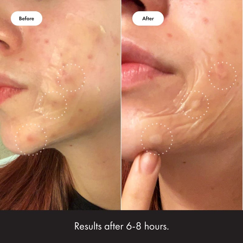 Mighty Patch رقعة سطحية من Mighty Patch Hero Cosmetics - رقعة مائية غروانية للجسم والخدود والجبهة والذقن (10 قطع) - Image 5