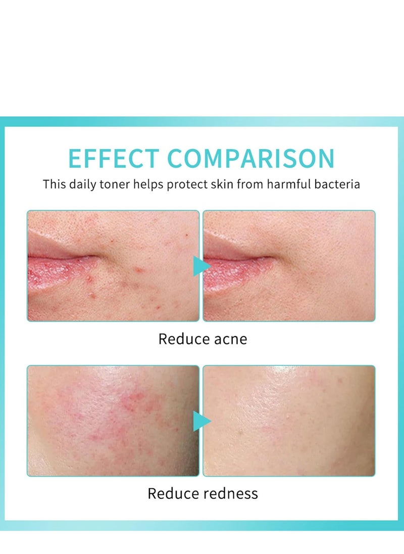 lakerain Hypochlorous Acid Face and Skin Spray,Facial Toner with Pure Hypochlorous,Face and Skin Renew Toner Spray,Moisturising Spray for Sensitive Skin,Acid Hypochlorous Acid Spray(1pcs)  - Image 4