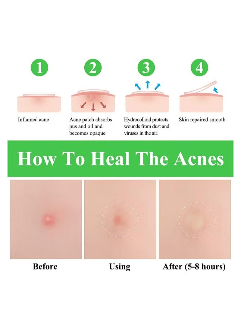 Breylee 66 Count Acne Pimple Patches - Hydrocolloid Transparent Spot Treatment for Face u0026 Body, Fast Absorbing Vegan Cruelty-Free Cover (Two Sizes) - Image 3