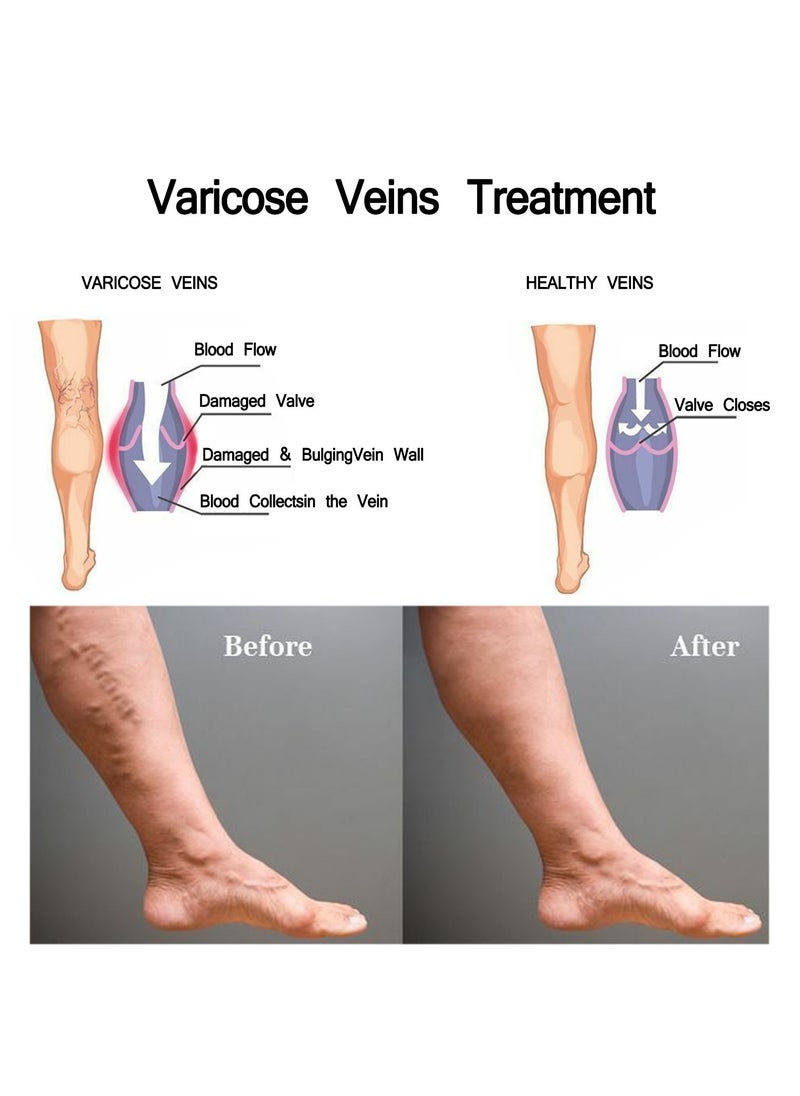 Varicose Veins Medical Cream, Eliminate Spider Veins Spray, Relieve Varicose Veins, Improve Blood Circulation, Relieve Leg Fatigue, Anti-Edema, Improve Blood Circulation and Quickly Reduce Swelling