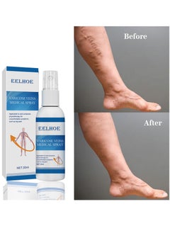 EELHOE Varicose Veins Medical Cream, Eliminate Spider Veins Spray, Relieve Varicose Veins, Improve Blood Circulation, Relieve Leg Fatigue, Anti-Edema, Improve Blood Circulation and Quickly Reduce Swelling  - Image 2