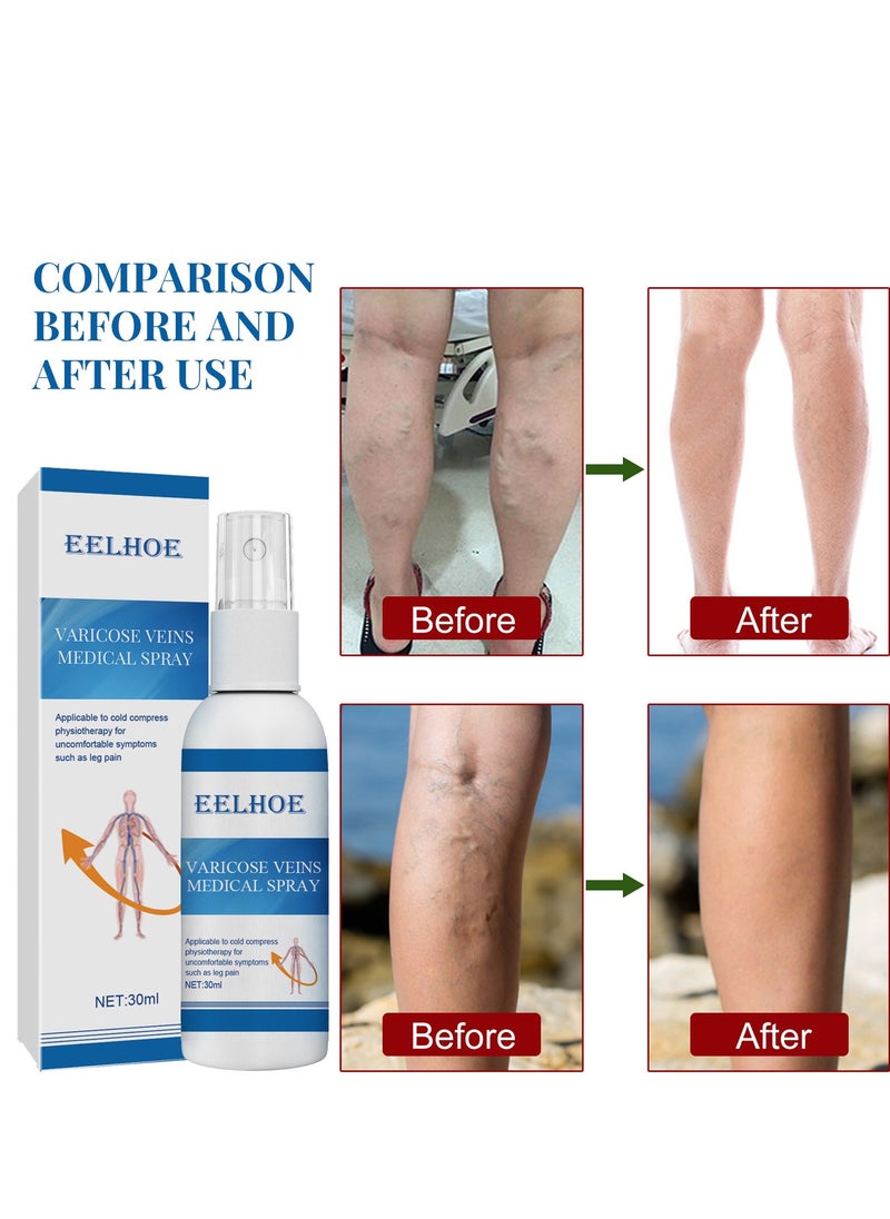 Varicose Veins Medical Cream, Eliminate Spider Veins Spray, Relieve Varicose Veins, Improve Blood Circulation, Relieve Leg Fatigue, Anti-Edema, Improve Blood Circulation and Quickly Reduce Swelling