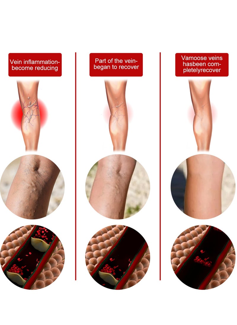 Varicose Veins Medical Cream, Eliminate Spider Veins Spray, Relieve Varicose Veins, Improve Blood Circulation, Relieve Leg Fatigue, Anti-Edema, Improve Blood Circulation and Quickly Reduce Swelling