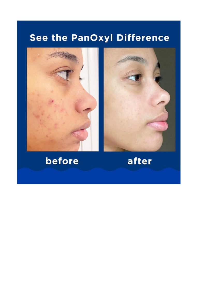 Original Panxol Peroxide 10% Acne Foaming Wash 156g  - Image 4