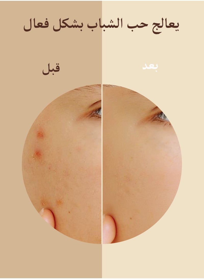 Muhratii - MUHRATII Microdart Acne Patch - Microneedle Pimple Patch Contains  322 Microdart and Hyaluronate Salicylic Acid Use for Blemish,Zit,Acne - 18 Patches - Image 1