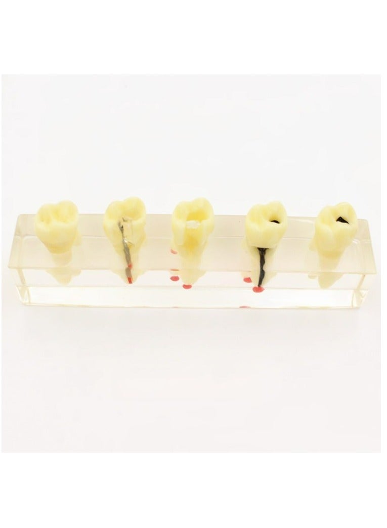 Dental Root Canal Treatment Teaching Model