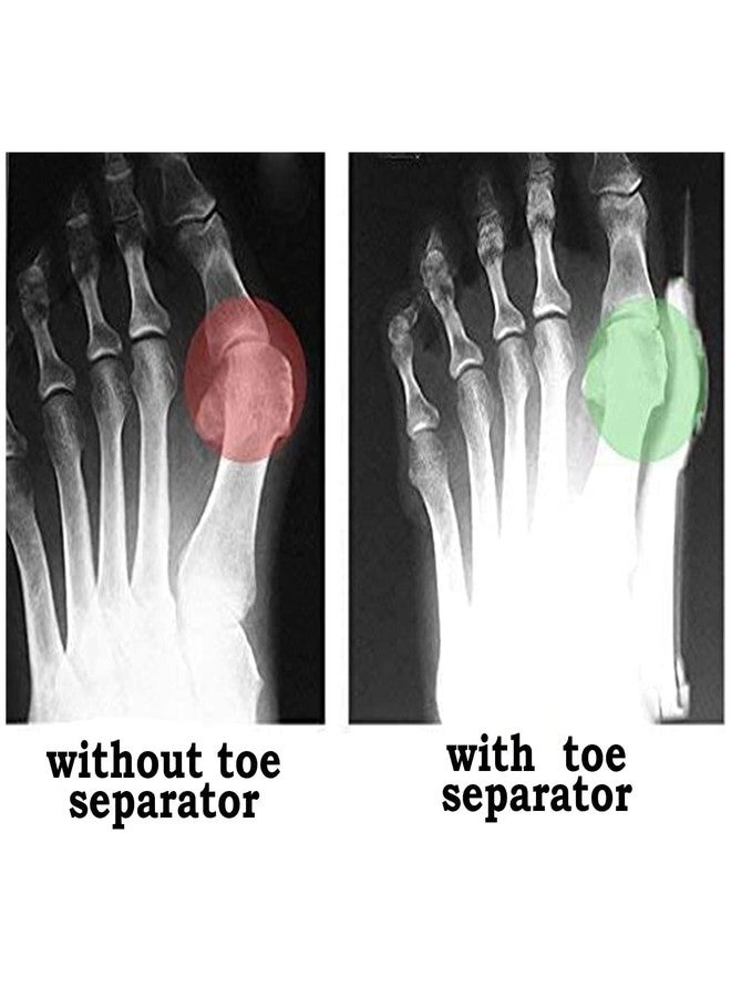 Dingger Toe Separator for Feet Toe Spacers Correct Toes Yoga Silicone Hammer Toe Corrector for Unisex Correct Toe Straighteners for Overlapping Toes - Image 3