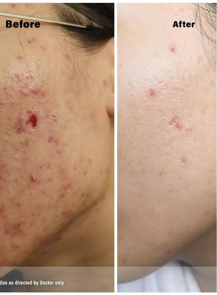 جمجوم فارما مجموعة من 4 عبوات كريم العناية بالبشرة أكريتين 0.05% علاج متكامل والحل الأمثل والنهائي لحب الشباب ومشاكل الجلد والبشرة 30 جم - Image 5