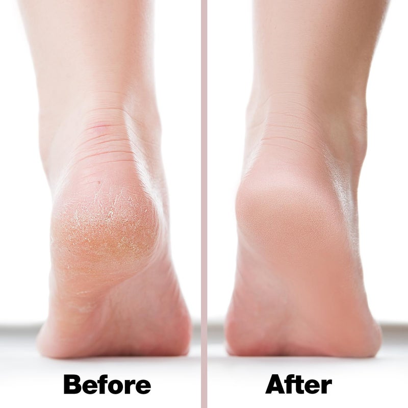 Probelle Double Sided Multidirectional Nickel Foot File Callus Remover - Immediately Reduces calluses and Corns to Powder for Instant Results, Safe Tool (Pink) - Image 4