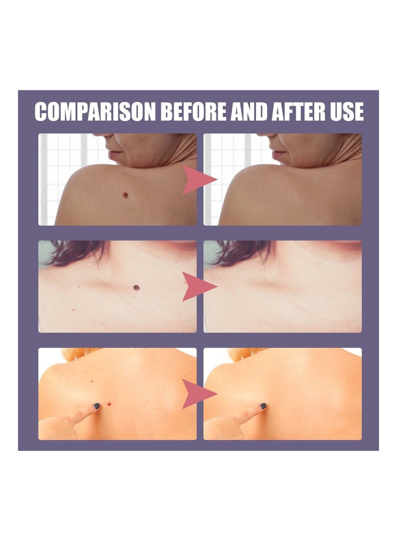 EELHOE Nevus Removing Cream 20g - Image 3