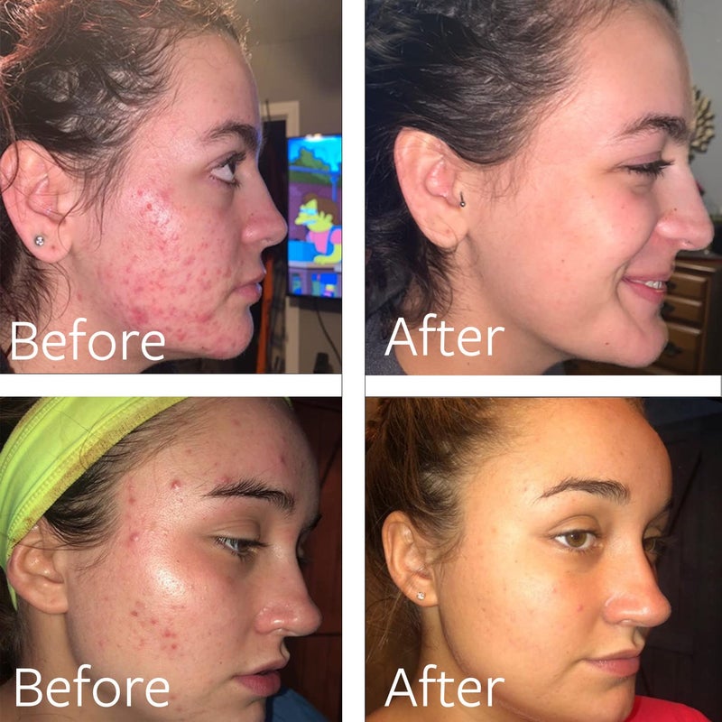 Dr Song غسول دكتور سونغ بيروكسيد البنزيل 10% لعلاج حب الشباب: غسول وجه وحب الشباب للجسم (8 أونصة سائلة (عبوة واحدة)) - Image 2