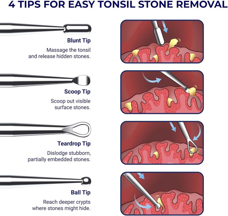 Oravix Metal Tonsil Stone Remover Tool Set - 2 Pack with 10 Silicone Tips - Image 4