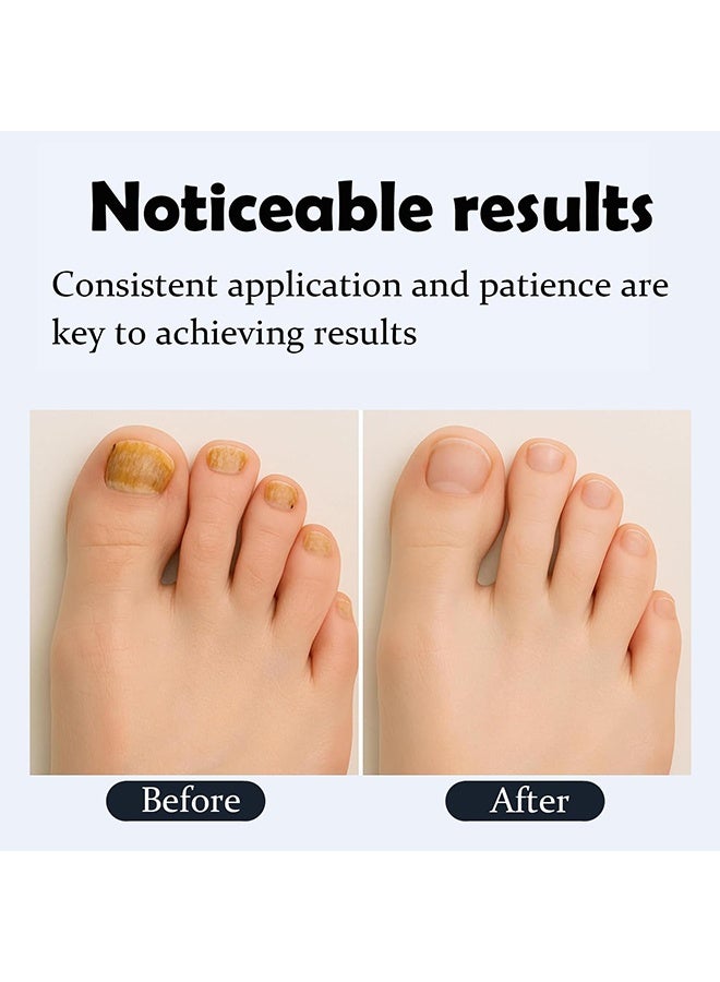 siimunana Antifungal pen, Undecylenic acid 25% Nail Fungus Treatment Pen, Fast-Acting Solution for Toe & Fingernail Fungi, Ideal for Nail Health Concerns Athletes - Image 5