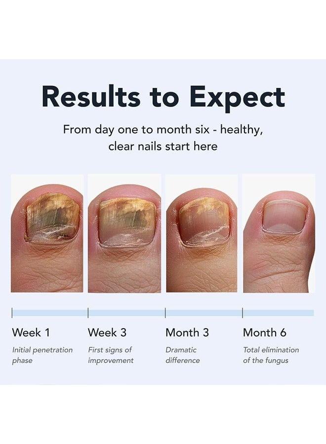 siimunana Antifungal pen, Undecylenic acid 25% Nail Fungus Treatment Pen, Fast-Acting Solution for Toe & Fingernail Fungi, Ideal for Nail Health Concerns Athletes - Image 4