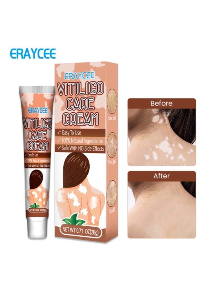 ERAYCEE Vitiligo Relief Cream 20G, Treatment for Skin Vitiligo Ointment, Fade White Spot and Improve Skin Pigmentation Cream, Vitiligo Cream for Skin Healthy Care - Image 1