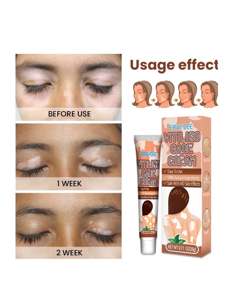 ERAYCEE Vitiligo Relief Cream 20G, Treatment for Skin Vitiligo Ointment, Fade White Spot and Improve Skin Pigmentation Cream, Vitiligo Cream for Skin Healthy Care - Image 3