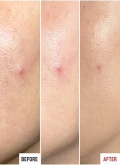 erborian ERBORIAN Centella SOS Patch Gel - Targeted Button Patch Effect for Blemishes 9ml  - Image 4