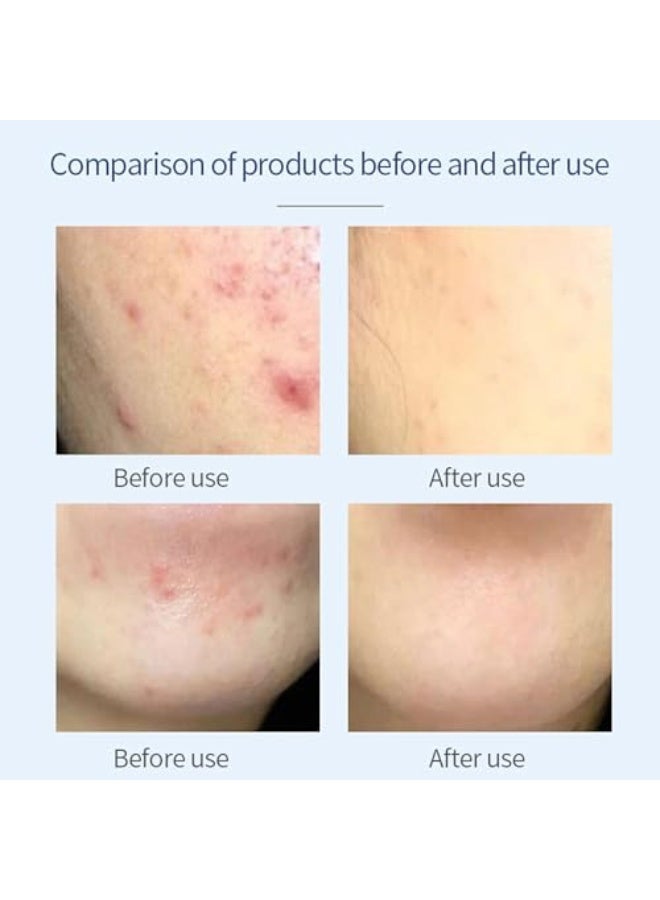 PUVIDA Acne Treatment Acne Control Cream for Face - Acne Gel Fast Absorbing Spot Treatment - Reduces Blemishes & Breakouts - Without Over Drying - Image 5