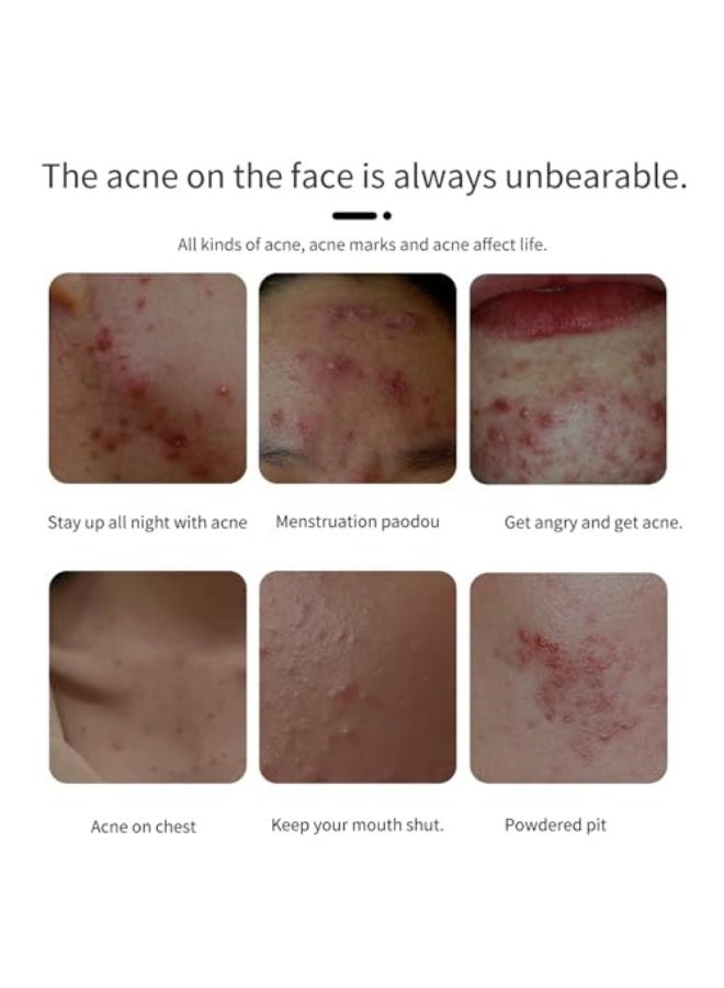 PUVIDA Acne Treatment Acne Control Cream for Face - Acne Gel Fast Absorbing Spot Treatment - Reduces Blemishes & Breakouts - Without Over Drying - Image 2