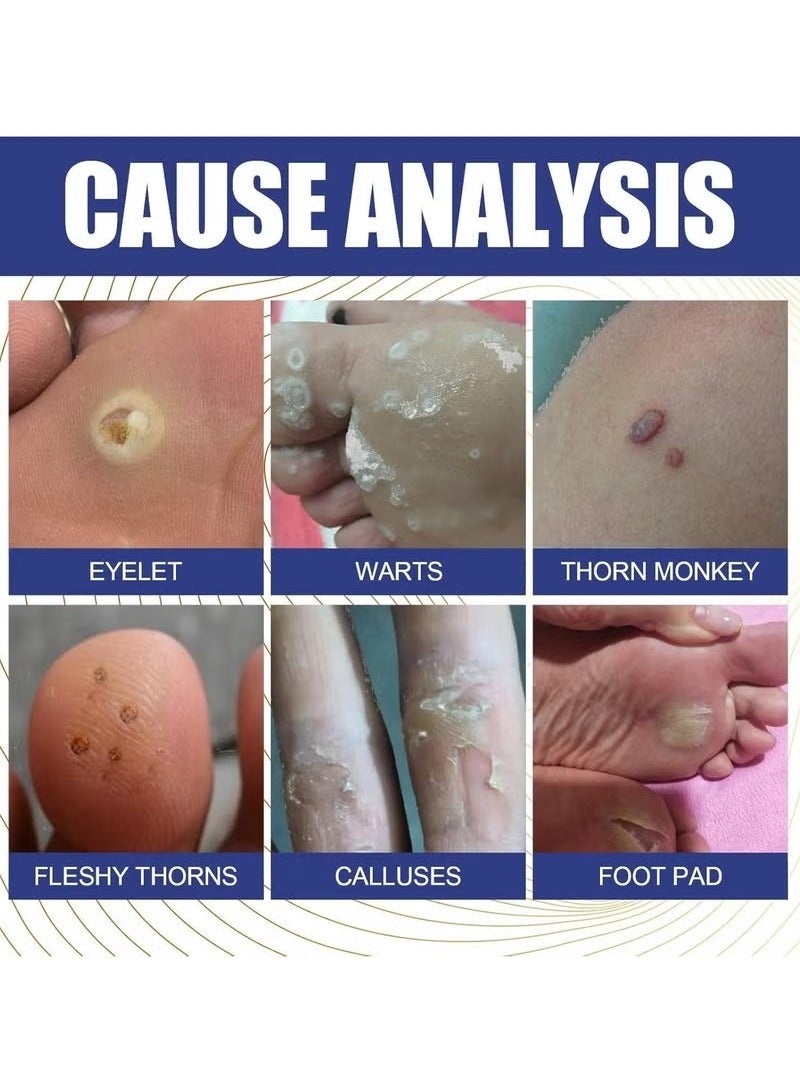 Lanthome Wart Remover, Fast Acting and Painless Skin Tag Remover Liquid, Tags and Mole Remover, Tag-Remover for Hands and Body, Wart Cream for Genital Warts, Plantar Wart, Common Wart, Corn, Flat Wart - Image 4