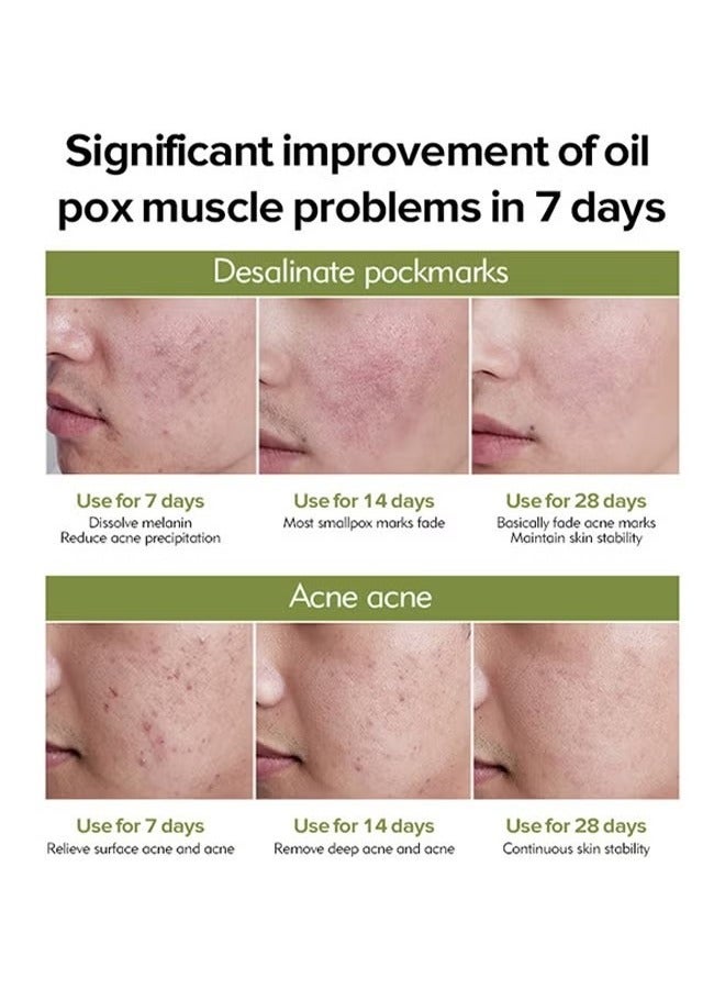 LANEMAY Natural- Tea Tree Anti Acne Cream,Soothing And Deep Repair, Repair Acne Scar Balance, Natural Cystic Acne Treatment, For All Skin Types 30g - Image 3
