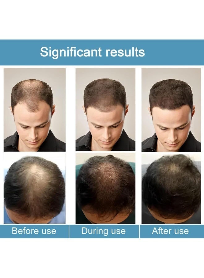 Liexuan Alphainfuse Hair Regrowth System, Advanced Hair Growth Treatment Serum for Thicker, Fuller Hairs, Strengthens Roots, Gentle Painless, Supports Healthy Hairs Growth for Men & Women (1Pcs) - Image 2