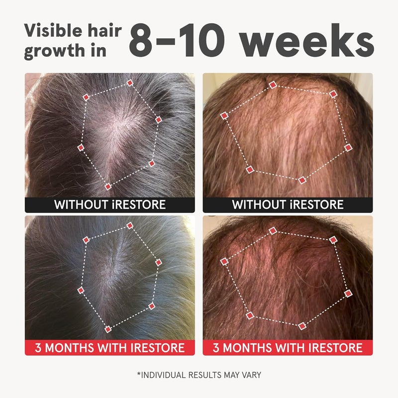 iRestore Advanced Hair Growth Supplement for Women Hair Vitamins for Faster Hair Regrowth Best for Hair Loss and Thinning  1 Month Supply Each  30 Count Pack of 3  Black - Image 2