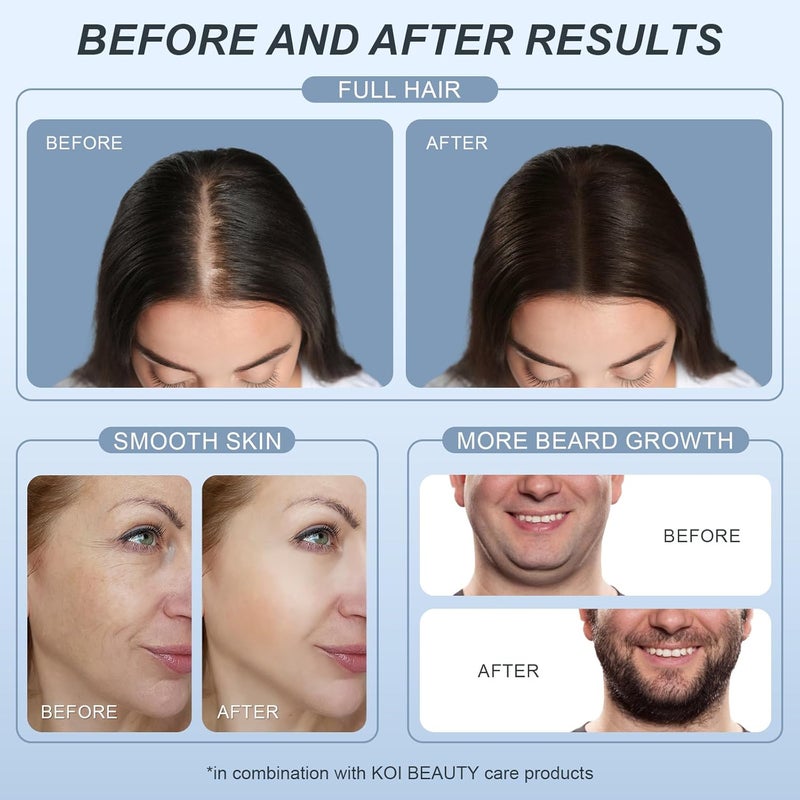 Adjustable Microneedling Derma Stamp - 140 Titanium Pins Professional Microneedle Dermapen for Hair, Beard Growth, Face, Body - Best Derma Roller Alternative - Image 5