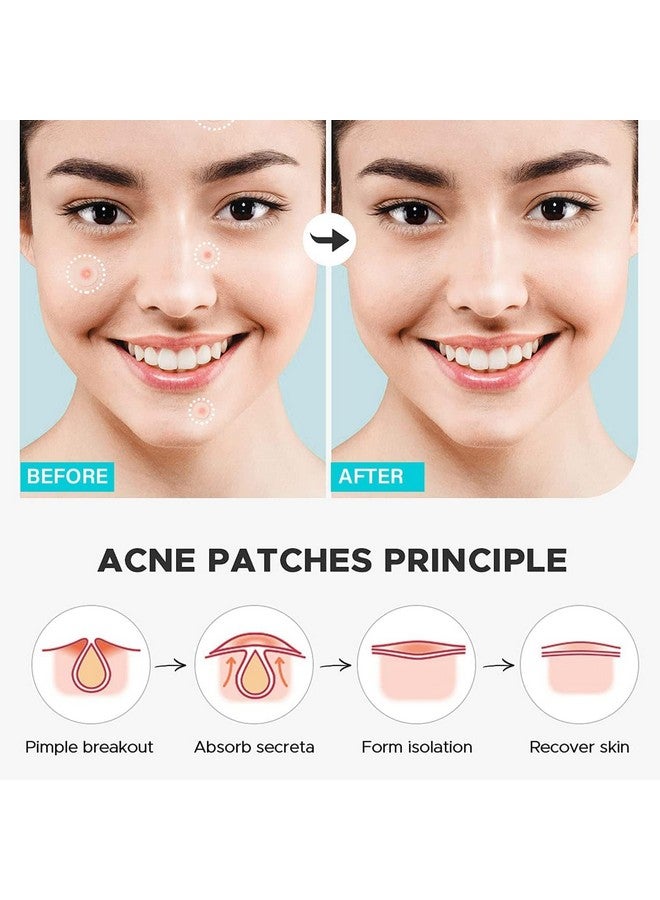 Pristar Pimple Patch | 72 Hydrocolloid and Salicylic Acid Patches | Absorbs Oil, Prevents Scarring | Overnight Treatment | For All Skin Types | Acne Patches for Face - Image 4