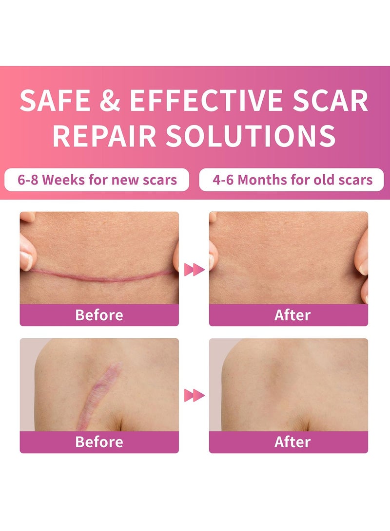 Joudi Professional Silicone Scar Removal Sticker for Post-Surgery C-Section Stretch Marks - Reusable Breathable Anti-Sun (4cm x 150cm)  - Image 3