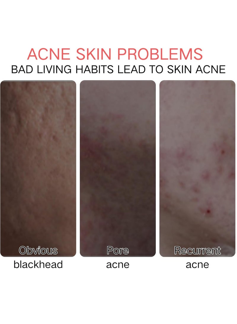 FUSHITING Azelaic Acid 15% Acne Tratment Cream, Acne Cream for Face, Spot Treatment, Anti Acne Gel For Spot Prone Skin, Rosacea Reducing Relief Pimple Breakouts Blackhead Pigmentation and Redness,Hydrate 15g - Image 3
