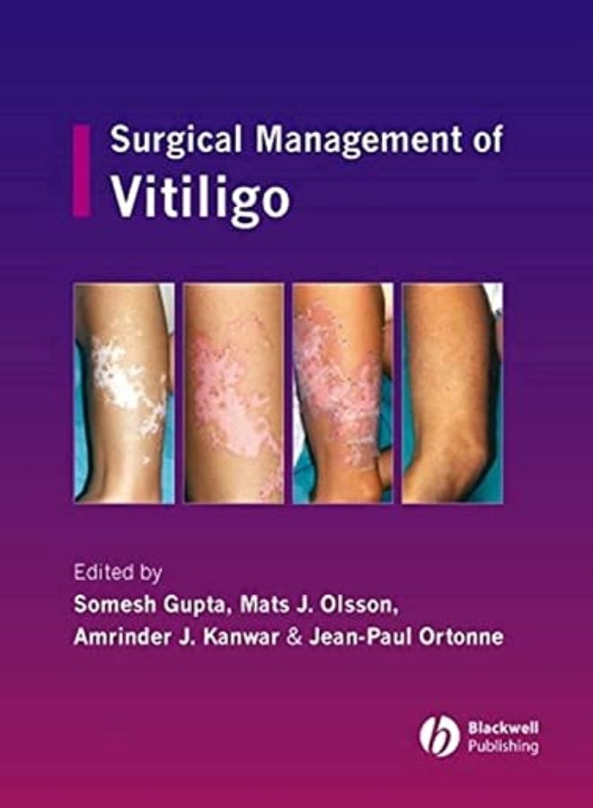Surgical Management of Vitiligo 