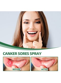 SOUTH MOON Canker Sore Treatment Spray 20ml，Herbal Ulcer Treatment,Natural Mouth Sore Relief for Daily Oral Care, Mouth Spray,Treat Mouth Ulcer,Effective Mouth Sore Treatment  - Image 2